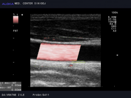 Ultrazvok vratnih žil - normalen izvid skupne karotidne arterije